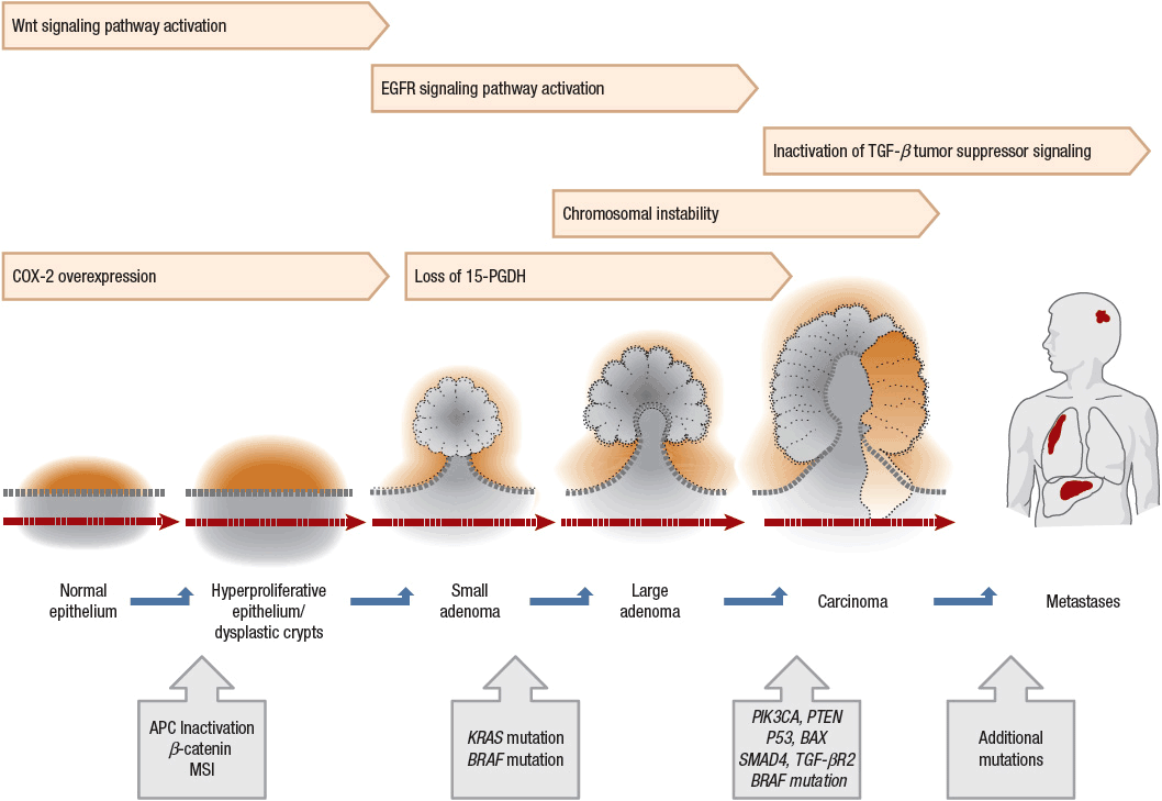 Colorectal Cancer Pathophysiology