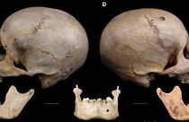 Der 4.000 Jahre alte Schädel trägt Spuren der möglicherweise frühesten Krebsbehandlung überhaupt.