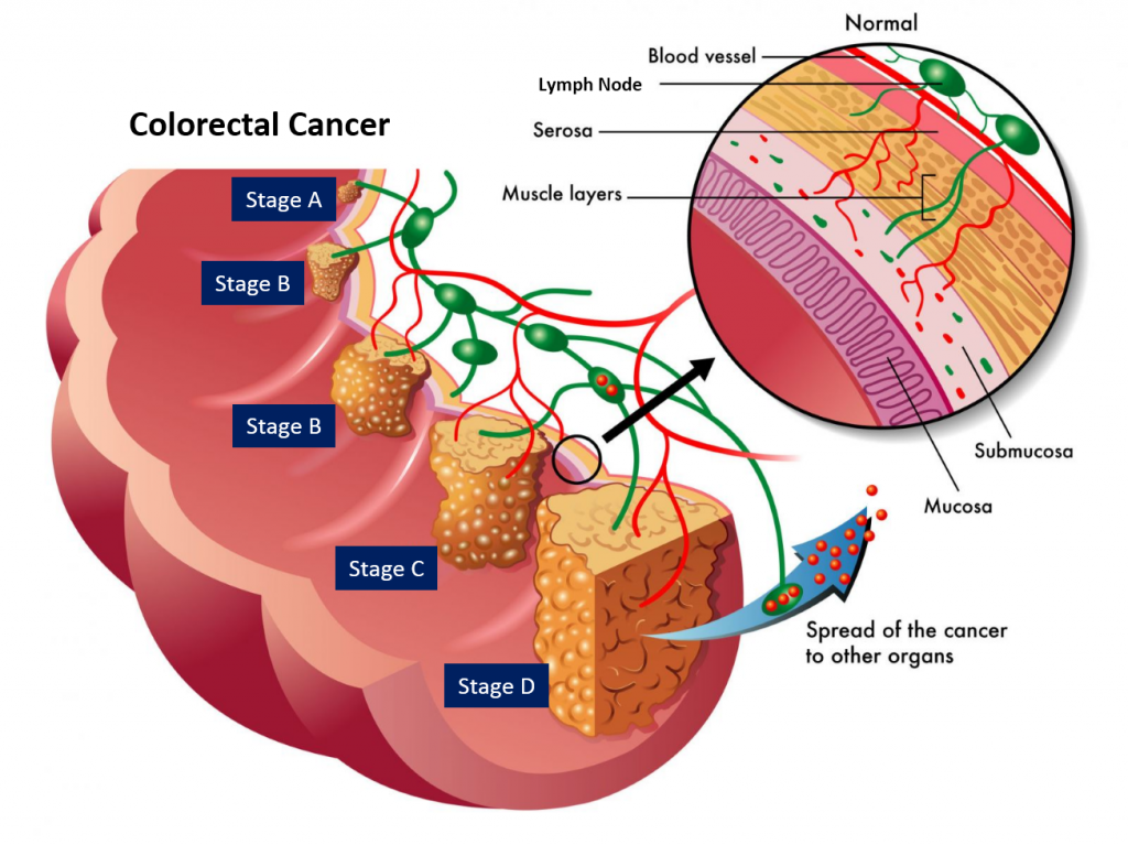 Colorectal Cancer System Disorder Template