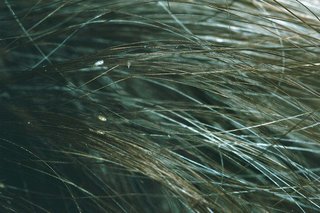 Small brown and white head lice eggs attached to brown hair on the scalp.