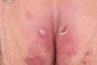 A pressure ulcer on the bottom of someone with white skin. There's a large pink patch on the skin with a smaller, red open sore on part of it.