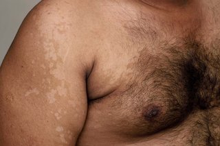 Pityriasis versicolor on the chest and upper arm of someone with brown skin. The skin is covered in large patches that are paler than the surrounding skin.