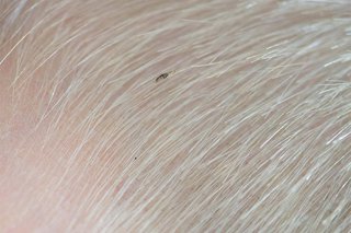 A head louse in blonde hair on the scalp of someone with white skin.