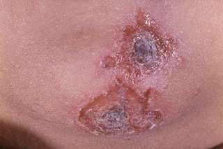 Impetigo on the chin. There a 2 patches that have dark brown scabs in the middle surrounded by lighter areas of weeping skin. Shown on medium brown skin.