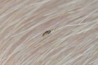 A close-up of a head louse in blonde hair on the scalp of someone with white skin. The louse is light brown and shaped like a rice grain.