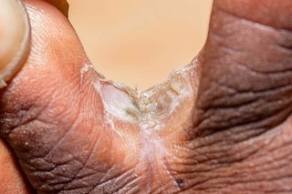 Athlete's foot on dark brown skin. Close-up of 2 toes. Between the toes is a scaly white and green patch.