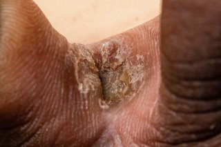 Athlete's foot on dark brown skin. Close-up of 2 toes. Between the toes is a flaky, dark brown and slightly white patch.