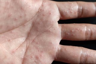 Pompholyx on the hand of someone with white skin. The palm and fingers are covered with small spots, some of which are fluid-filled blisters.