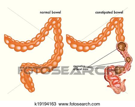 Constipation Clipart.