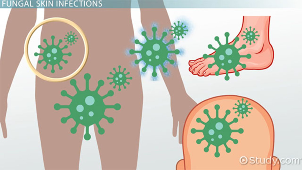 Fungal & Yeast Skin Infections Vocabulary.