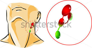 Swollen Lymph Nodes Clip Art.