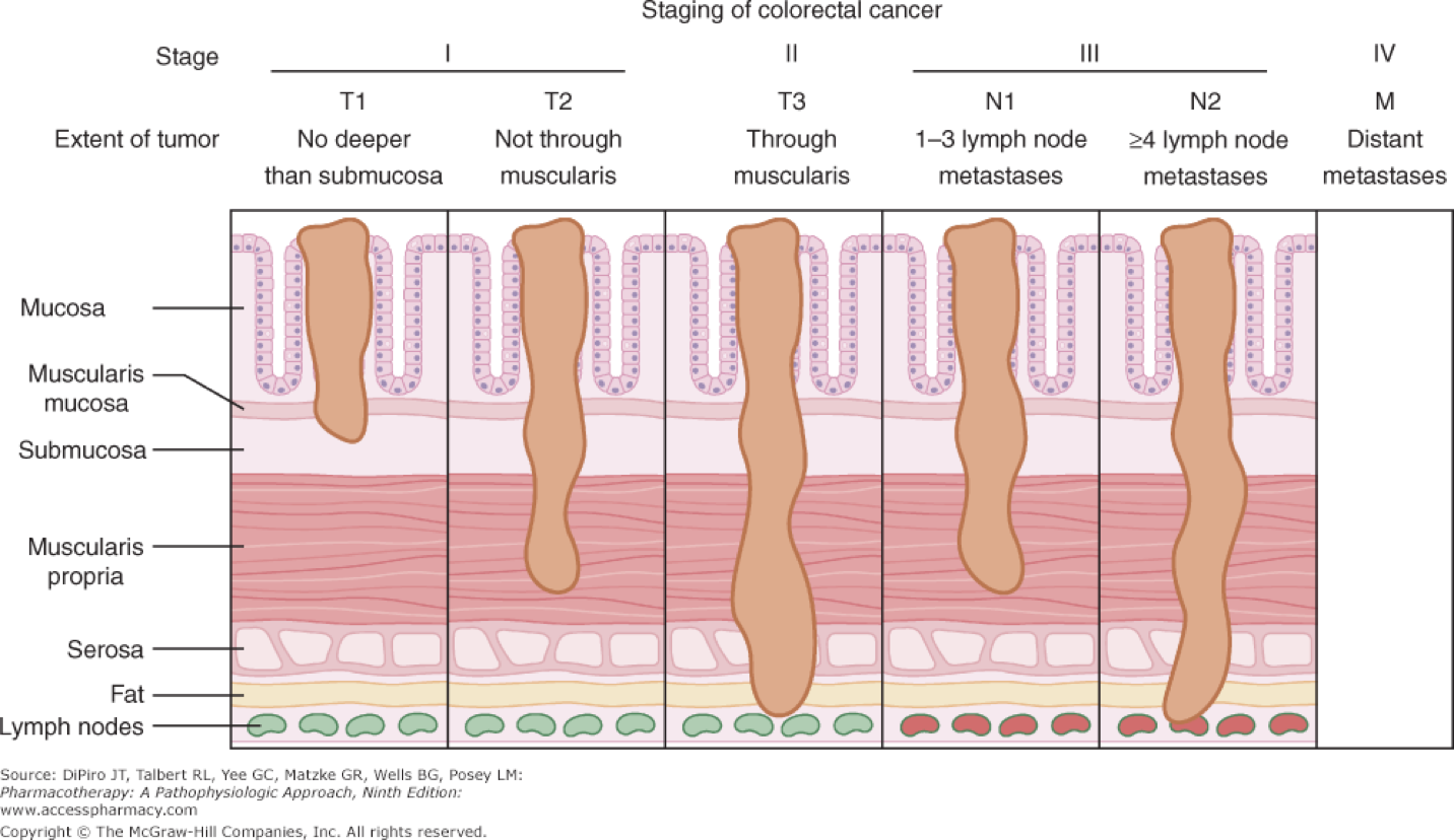 Signs Of Early Stage Colon Cancer - Cancer of the Colon / Colon cancer ...