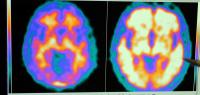 Hirnaufnahmen von einem gesunden Probanden (l.) und einem Alzheimerpatienten