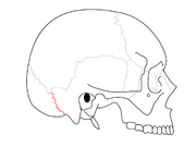 Sutura occipitomastoidea separando o osso occipital do mastoide do osso temporal.