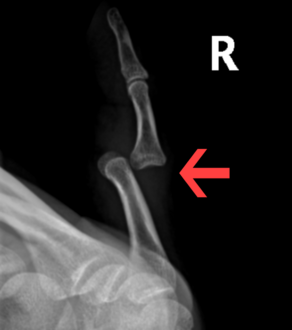 Radiograph of right fifth phalanx dislocation resulting from bicycle accident