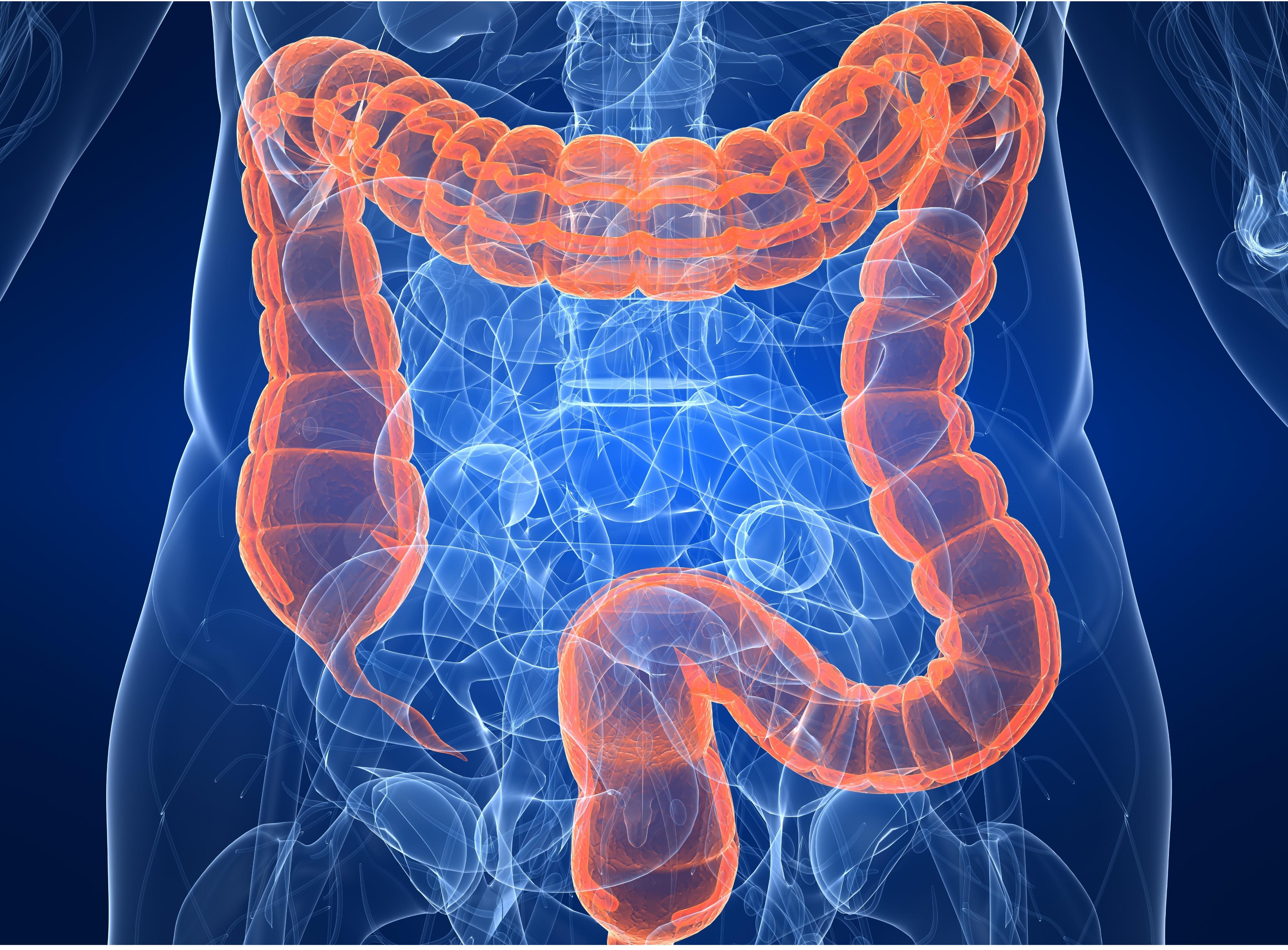 Colon Cancer: Symptoms, Stages, Causes, And Treatment, 41% OFF