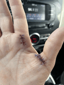 a close up of a person 's hand with stitches and a car radio in the background