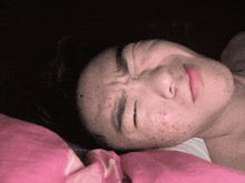 a young man with acne on his face is laying on a pink blanket