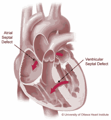 a diagram of a heart showing atrial septal defect and ventricular septal defect