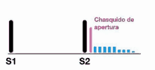 a diagram of a s1 and s2 line with a chasquido de apertura .