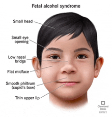 an illustration of a child 's face with fetal alcohol syndrome