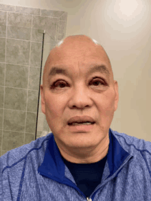 a bald man wearing a blue jacket has a stitch in his eye