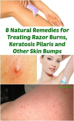 How To Take Care Of Razor Burn