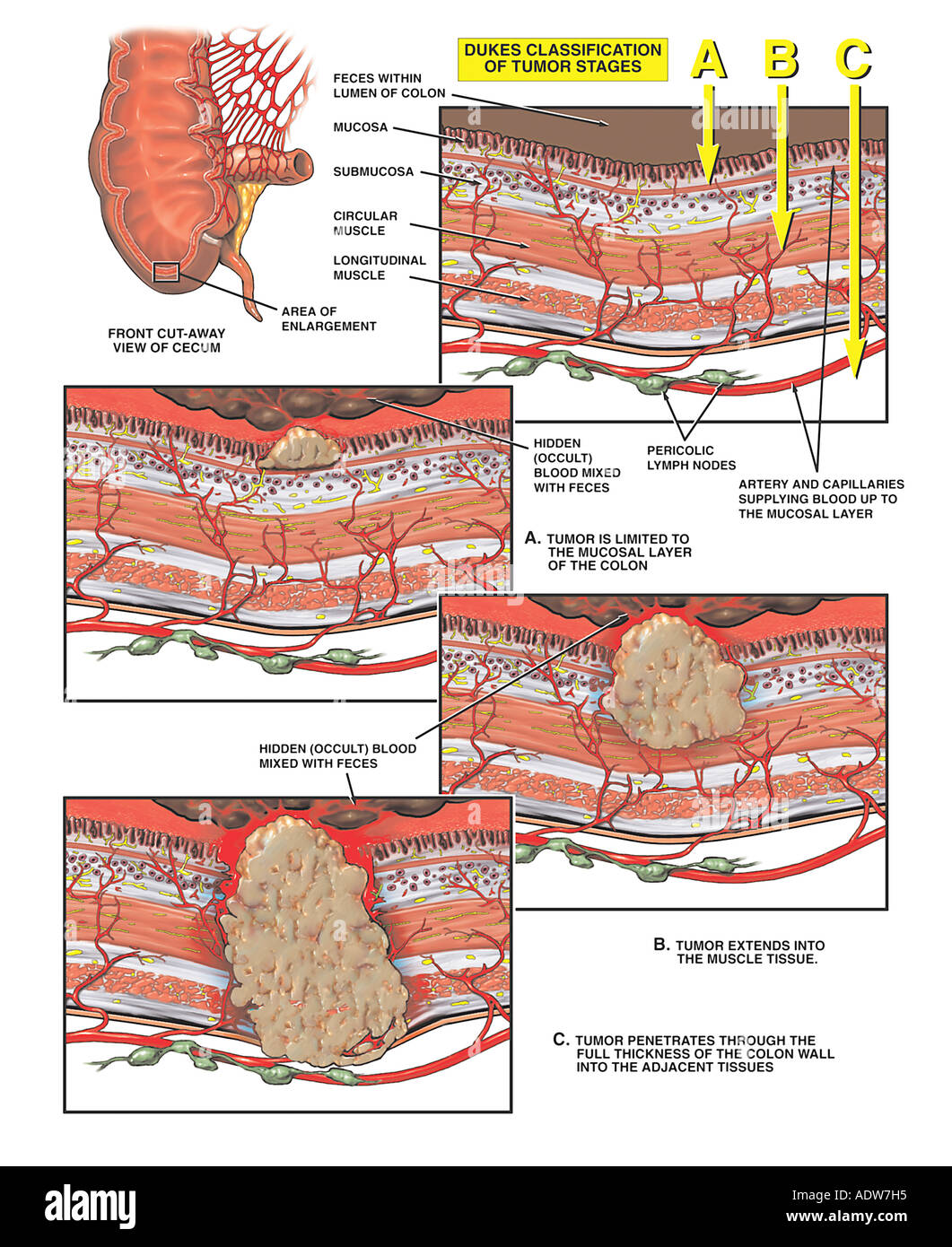 Colorectal Cancer Progression