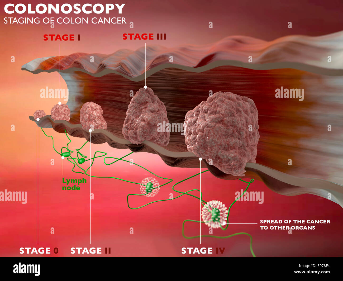 Stages Of Colorectal Cancer