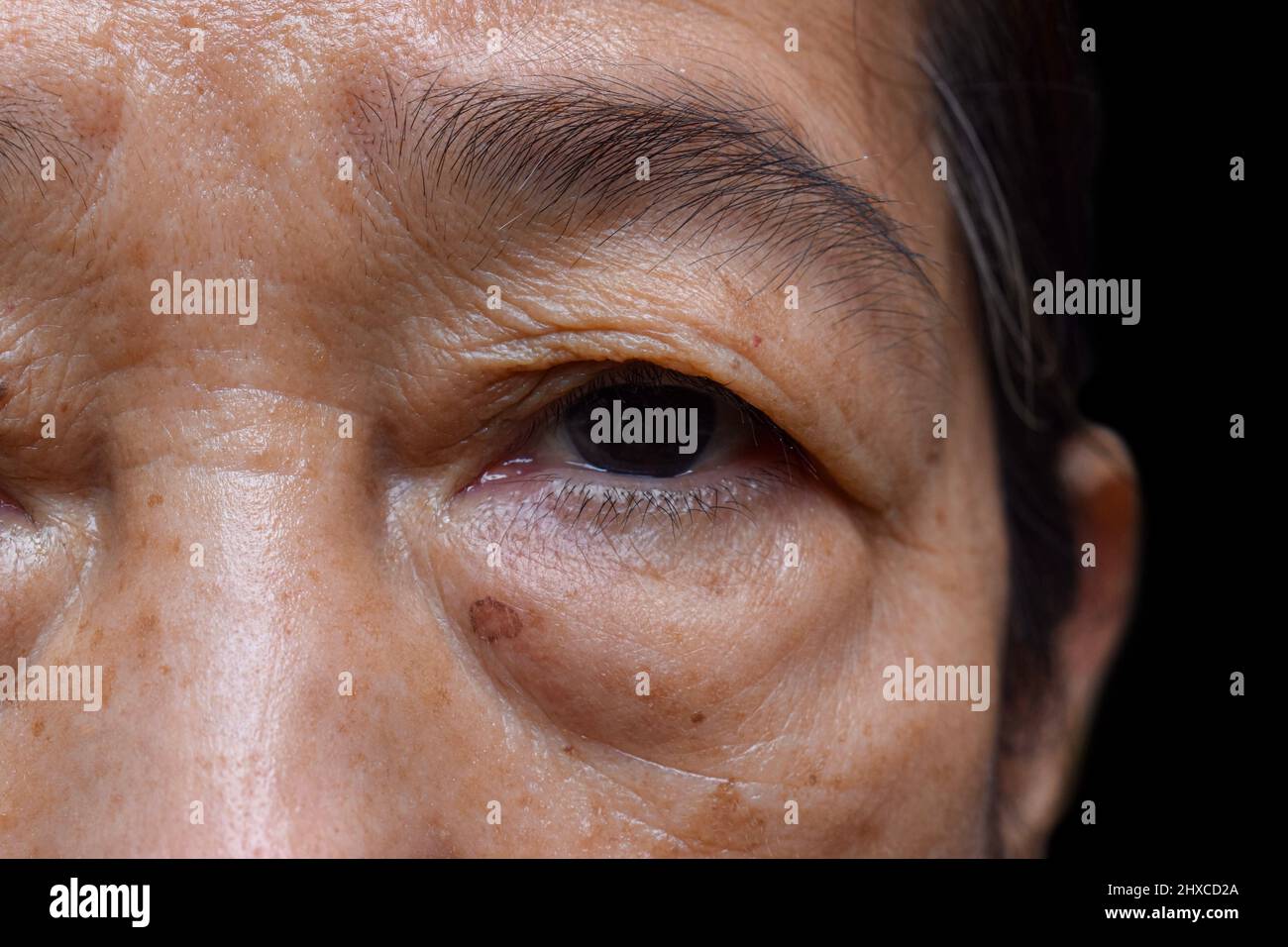 Prominenter Fettbeutel unter den Augen der älteren asiatischen Frau. Nahaufnahme. Stockfoto