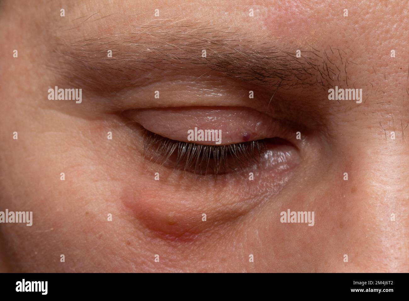 Geschwollene Augen durch Müdigkeit und Reizung. Nahaufnahme eines weiblichen Auges mit Säcken unter den Augen. Stockfoto