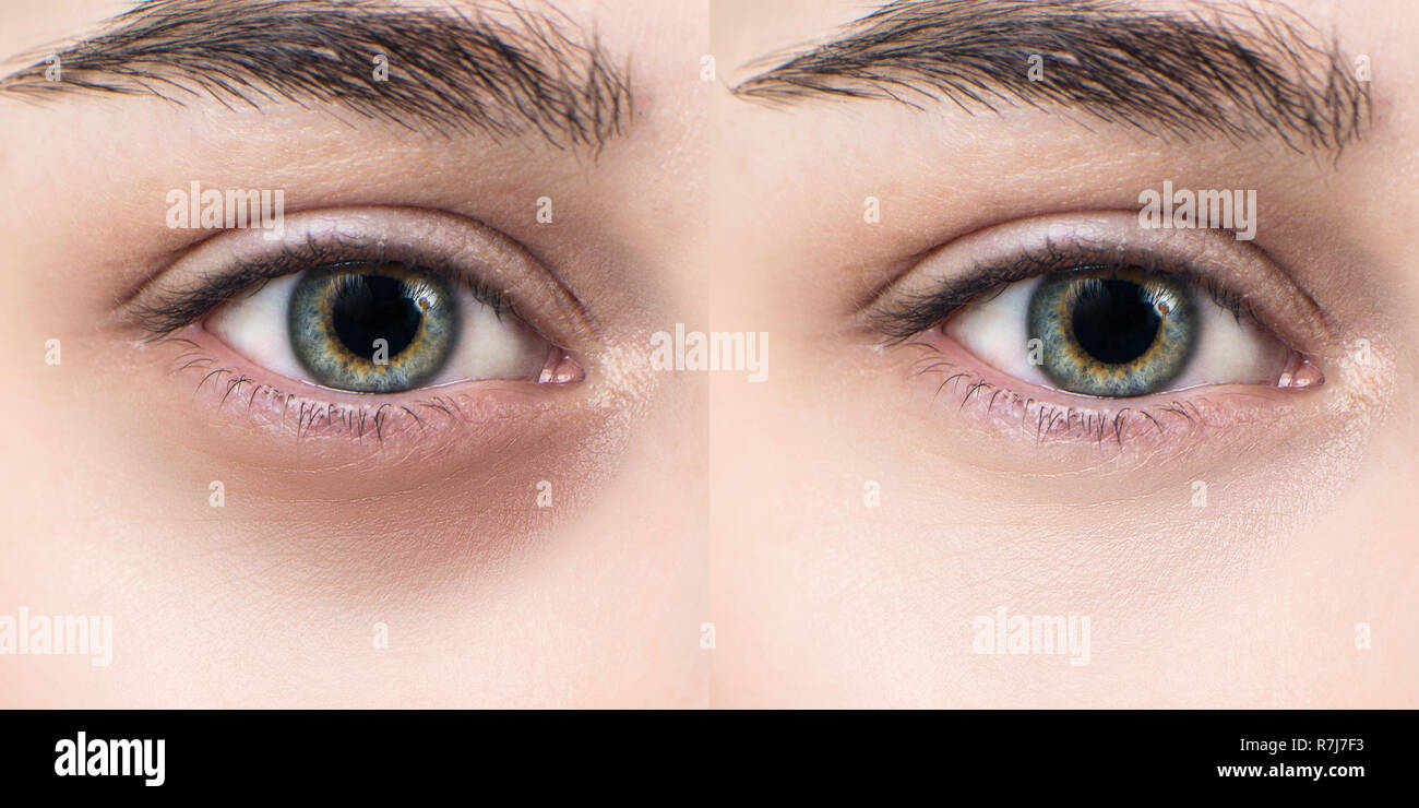 Weibliche Augen mit blauen Flecken unter den Augen vor und nach der kosmetischen Behandlung. Stockfoto