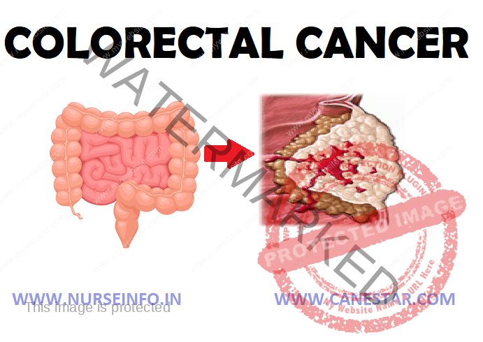 Colorectal Cancer Pathophysiology